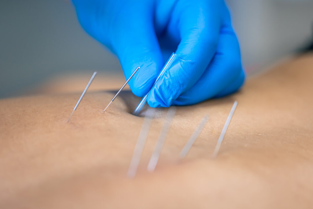 How long should you rest after dry needling?